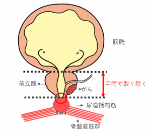 前立腺がん手術後の尿漏れ