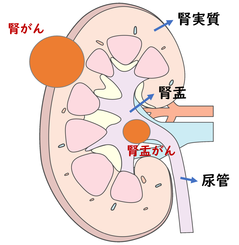 腎がん みうら泌尿器科クリニック