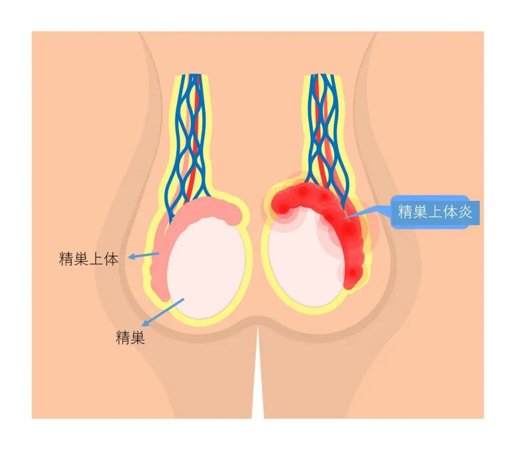 精巣上体炎 | みうら泌尿器科クリニック