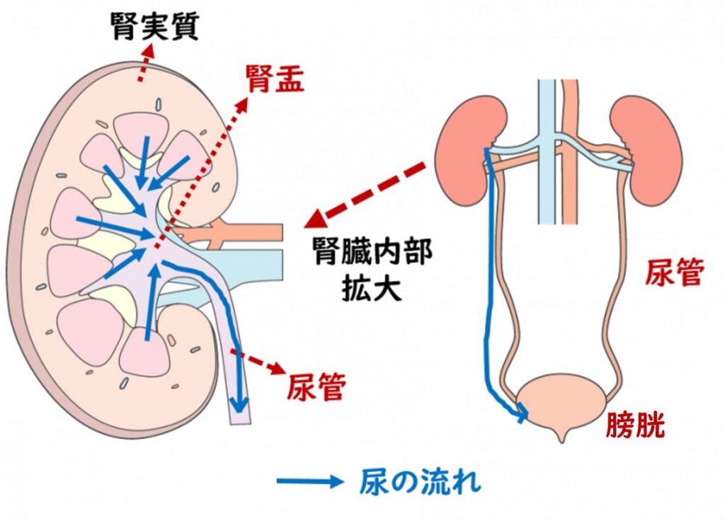 腎盂尿管がん みうら泌尿器科クリニック